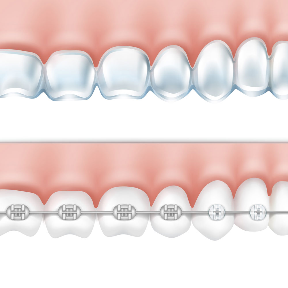 Invisible Braces - DAX Dental - Delray Beach Boca Boyton, Implants,  Dentist, Crowns
